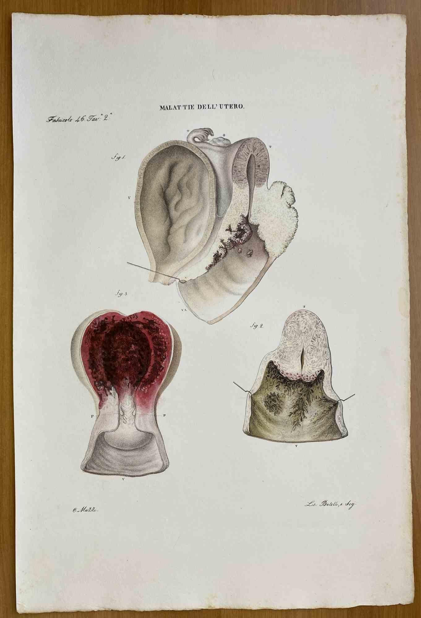  Diseases of Uterus ist eine handkolorierte Lithographie von Ottavio Muzzi für die Ausgabe von Antoine Chazal, Human Anatomy, Printers Batelli and Ridolfi, 1843.

Das Werk gehört zum Atlante generale della anatomia patologica del corpo umano von