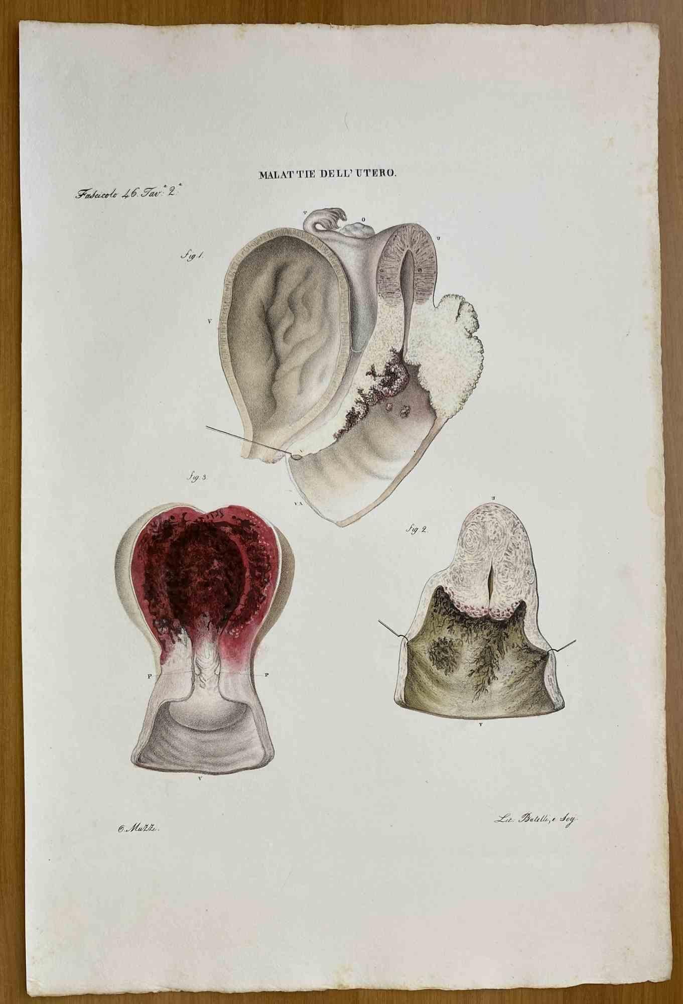  Diseases of Uterus is a lithograph hand colored by Ottavio Muzzi for the edition of Antoine Chazal, Human Anatomy, Printers Batelli and Ridolfi, 1843.

The work belongs to the Atlante generale della anatomia patologica del corpo umano by Jean