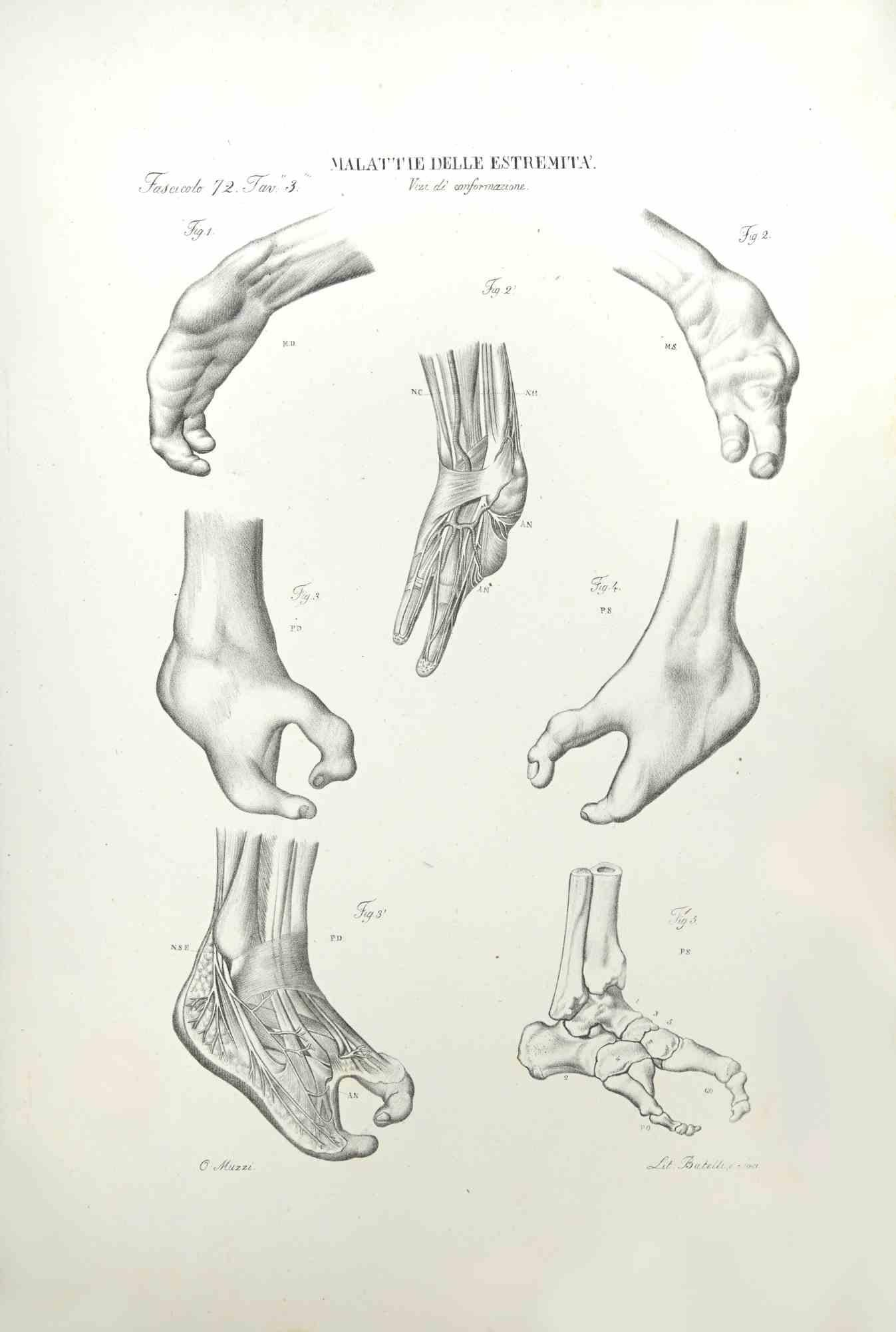 Extremity Diseases is a lithograph hand colored by Ottavio Muzzi for the edition of Antoine Chazal,Human Anatomy, Printers Batelli and Ridolfi, realized in 1843.

Signed on plate on the lower left margin.

The artwork belongs to the "Atlante