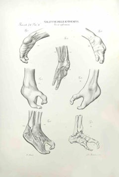Extreme Krankheiten – Lithographie von Ottavio Muzzi – 1843