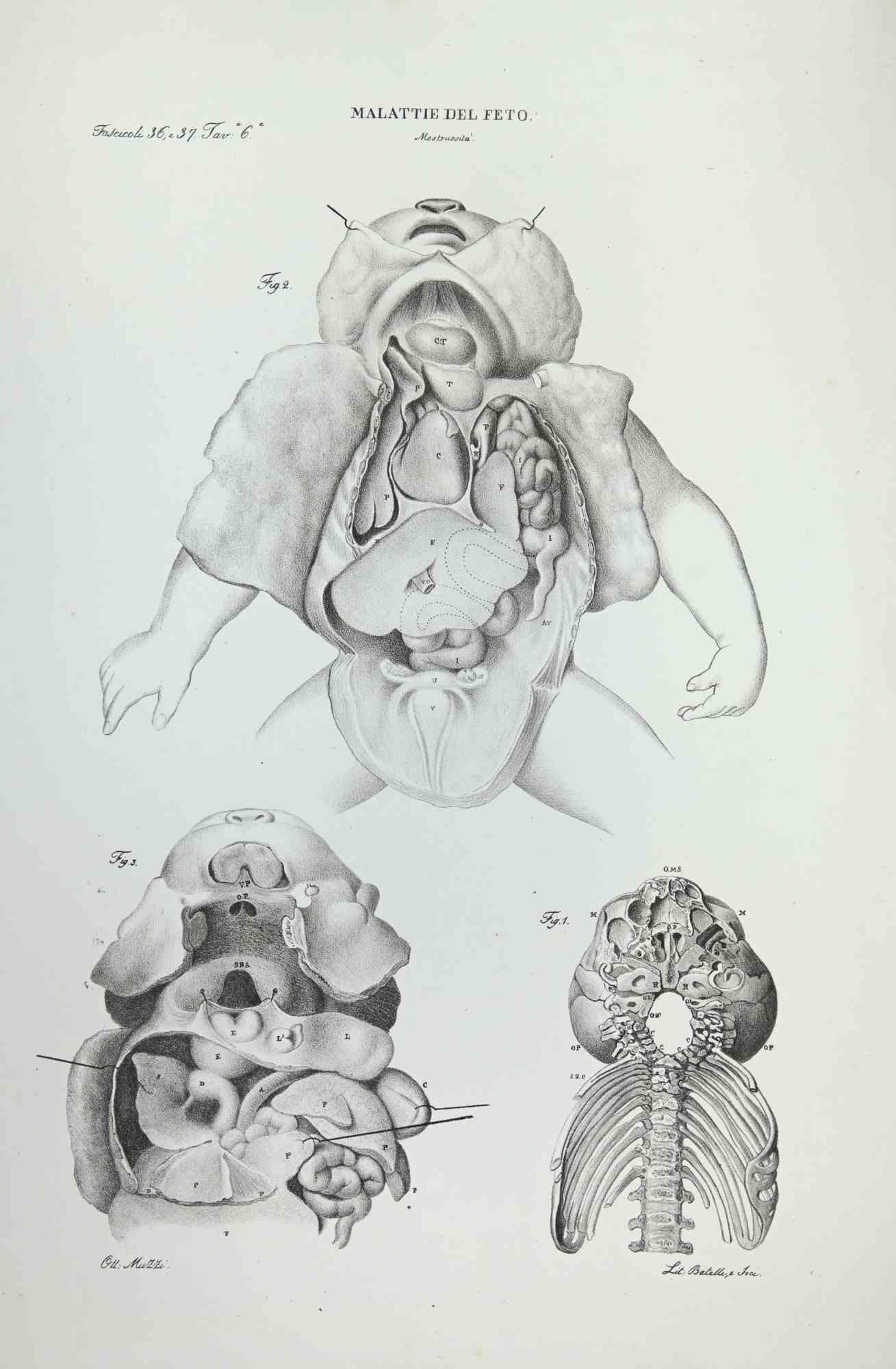 Fetus Diseases is a lithograph hand colored by Ottavio Muzzi for the edition of Antoine Chazal,Human Anatomy, Printers Batelli and Ridolfi, realized in 1843.
Signed on plate on the lower left margin. 

The artwork belongs to the "Atlante Generale