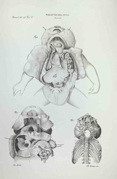 Fetus Diseases - Lithograph By Ottavio Muzzi - 1843