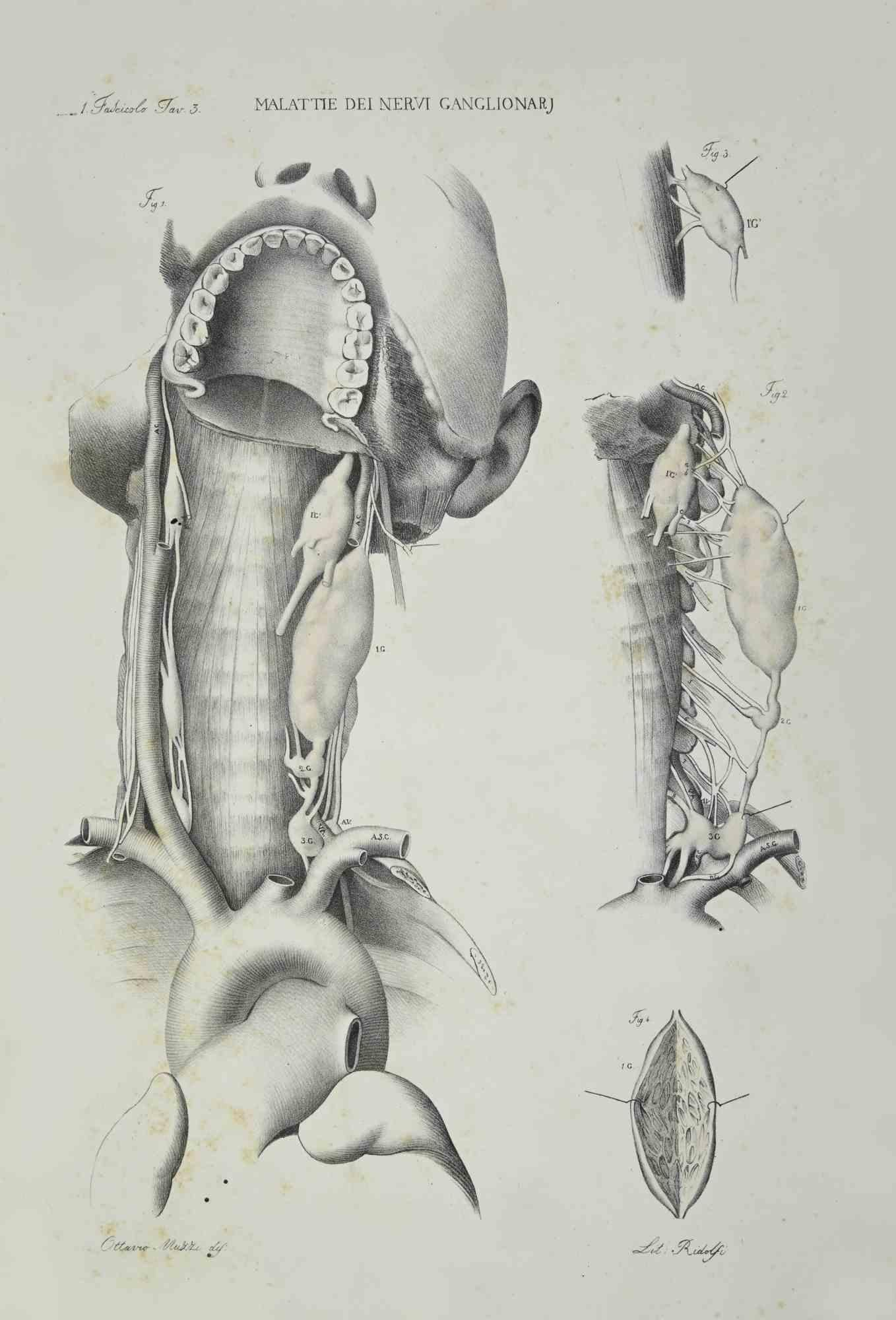 Ganglion Nerve Diseases is a lithograph hand colored by Ottavio Muzzi for the edition of Antoine Chazal,Human Anatomy, Printers Batelli and Ridolfi, realized in 1843.

Signed on plate on the lower left margin.