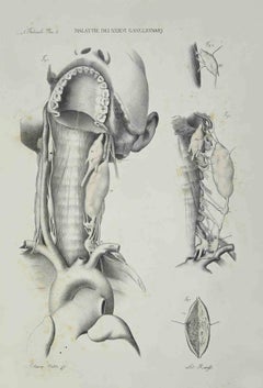 Ganglion- Nervenkrankheiten – Lithographie von Ottavio Muzzi – 1843