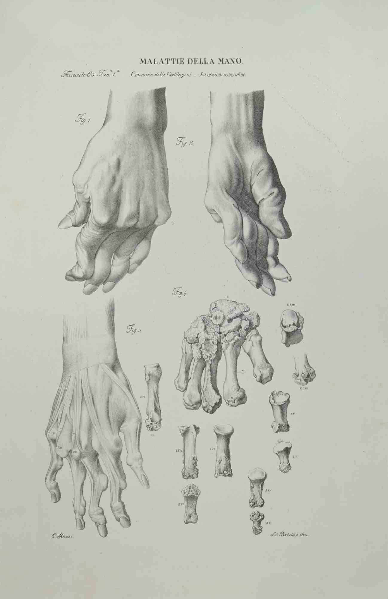 Hand Diseases is a lithograph realized by Ottavio Muzzi for the edition of Antoine Chazal, Human Anatomy, Printers Batelli and Ridolfi, 1843.

The work belongs to the Atlante generale della anatomia patologica del corpo umano by Jean CRUVEILHIER,