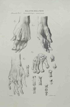 maladies de la main - Lithographie d'Ottavio Muzzi - 1843