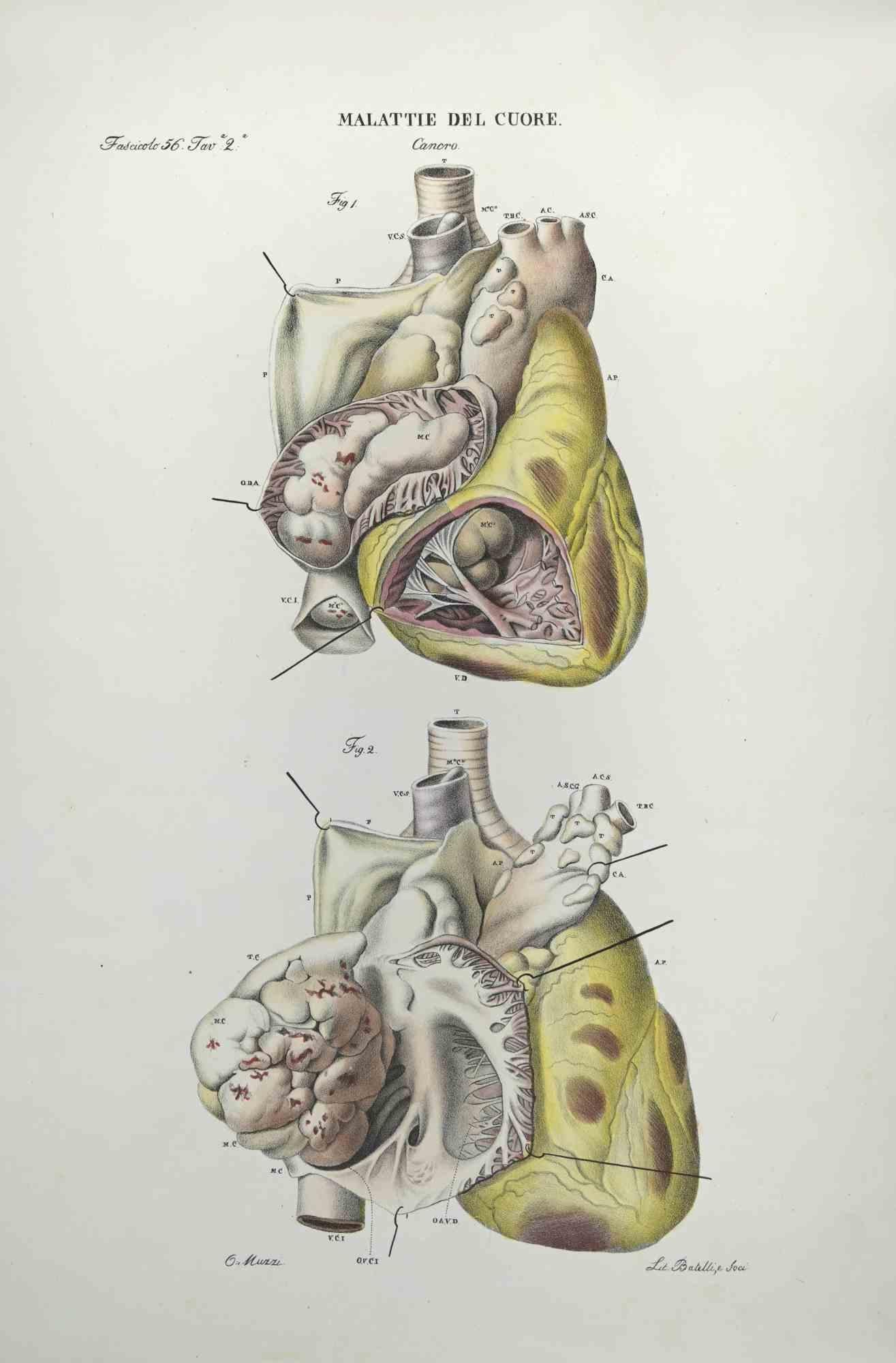 Lithographie de la maladie du cœur par Ottavio Muzzi - 1843
