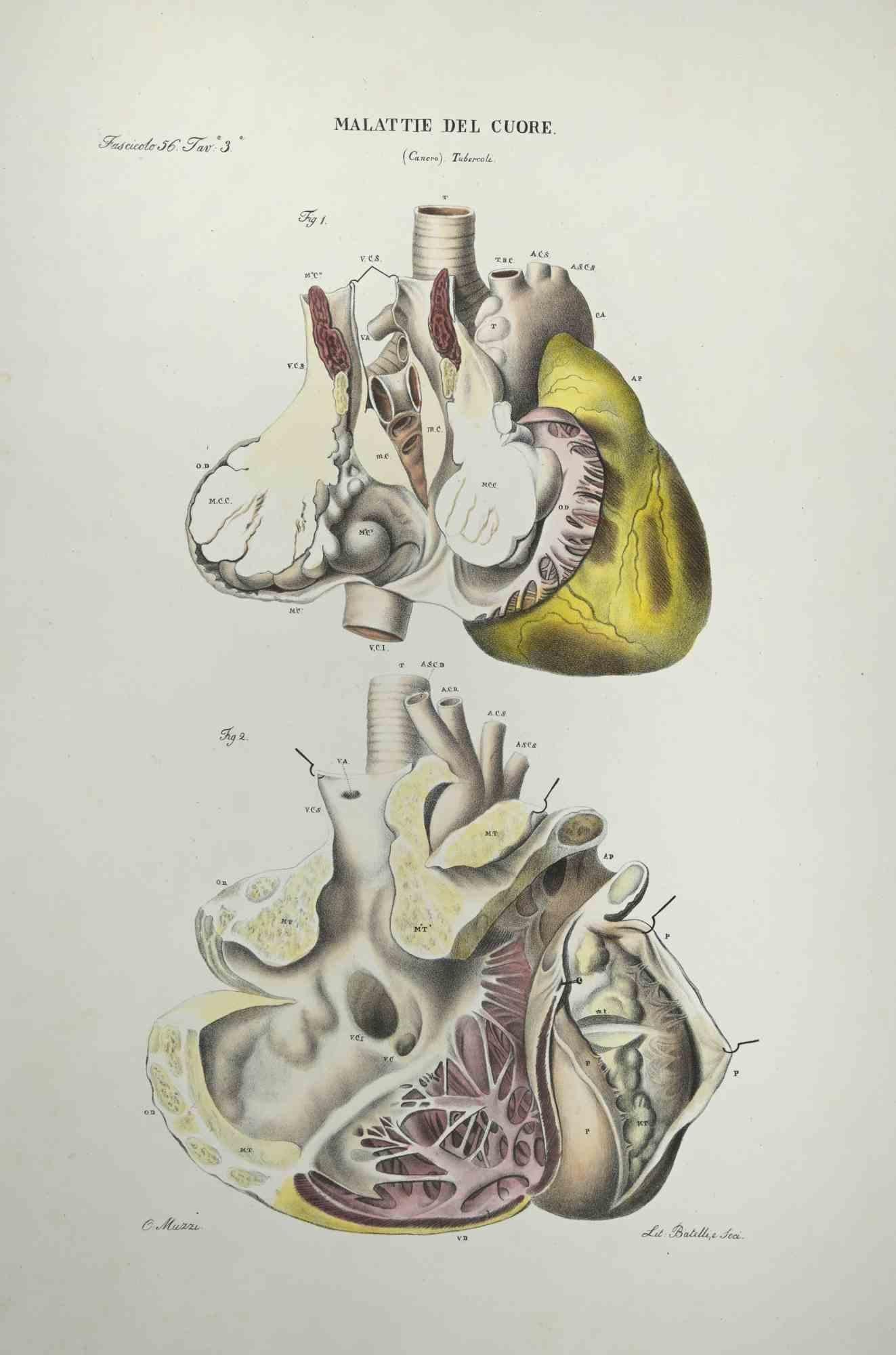 Heart Disease - Lithograph By Ottavio Muzzi - 1843