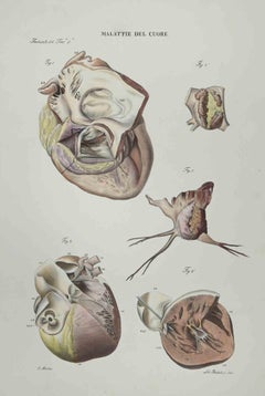 Herzkrankheit – Lithographie von Ottavio Muzzi – 1843