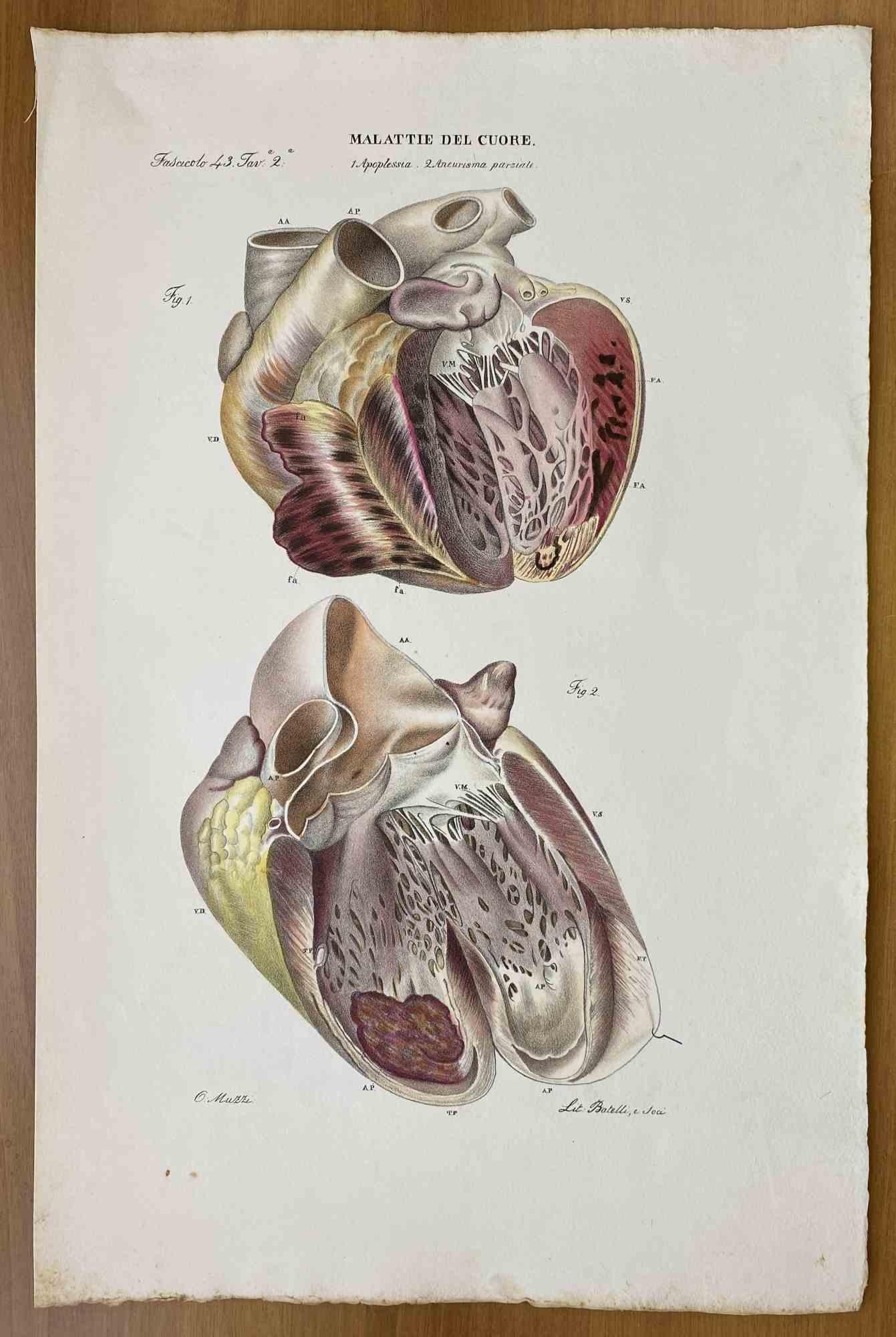 Lithographie « Heart Diseases » d'Ottavio Muzzi, 1843