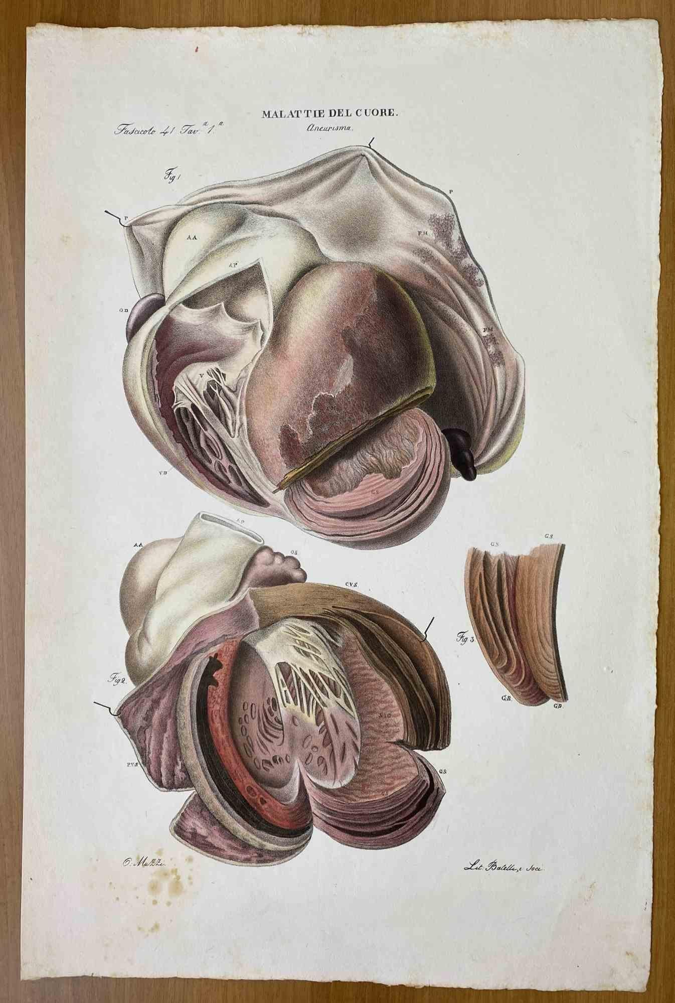 Herzkrankheiten ist eine handkolorierte Lithographie von Ottavio Muzzi für die Ausgabe von Antoine Chazal, Human Anatomy, Printers Batelli and Ridolfi, 1843.

Das Werk gehört zum Atlante generale della anatomia patologica del corpo umano von Jean