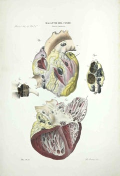 Lithographie « Heart Diseases » d'Ottavio Muzzi, 1843