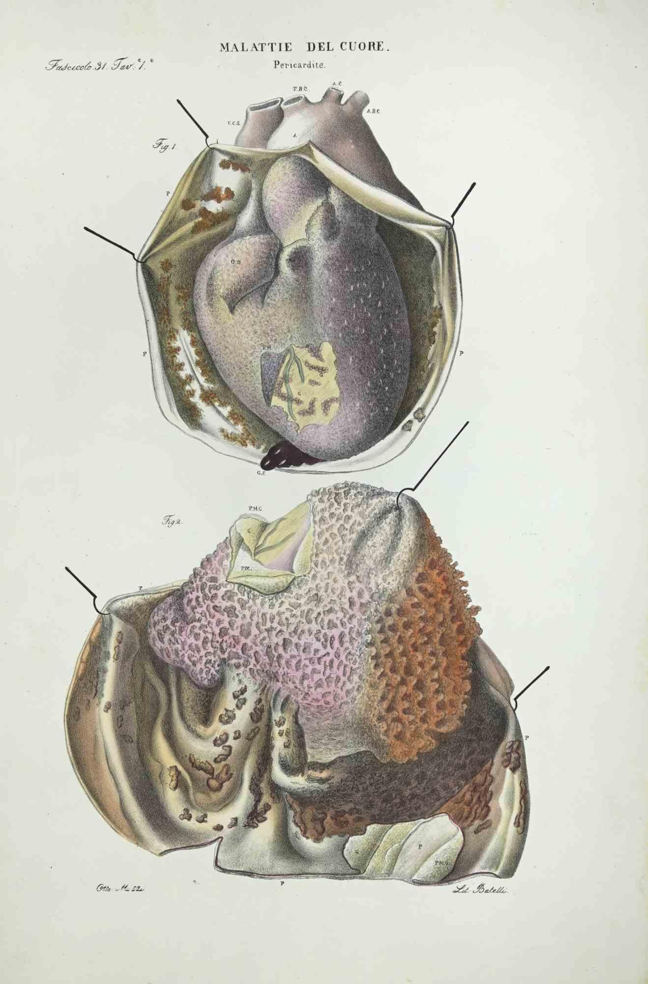 Maladies cardiaques est une lithographie coloriée à la main par Ottavio Muzzi pour l'édition d'Antoine Chazal, Anatomie humaine, Imprimeurs Batelli et Ridolfi, réalisée en 1843.

Signé sur la plaque dans la marge inférieure gauche.

L'œuvre
