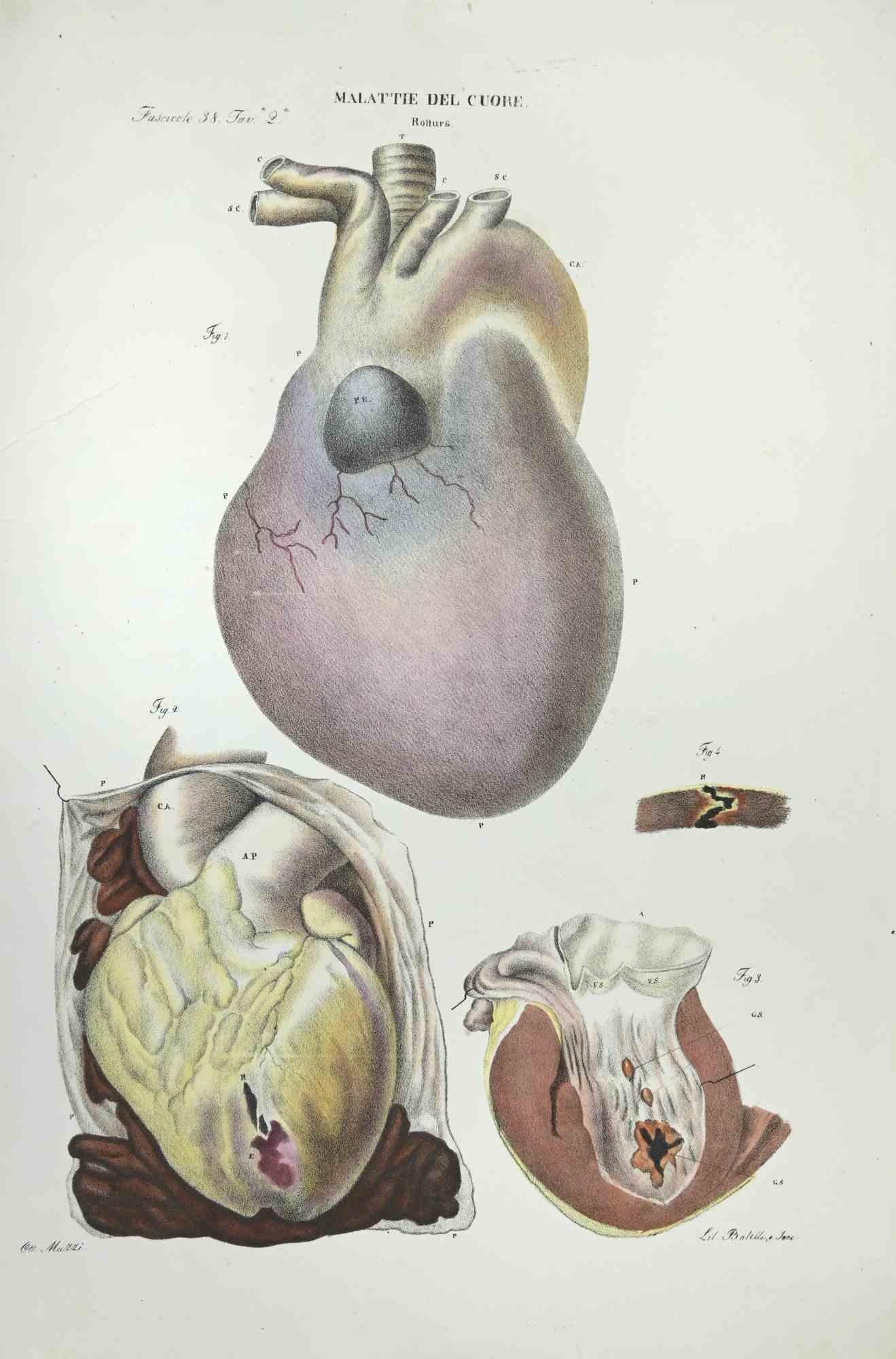 Heart Diseases is a lithograph hand colored by Ottavio Muzzi for the edition of Antoine Chazal,Human Anatomy, Printers Batelli and Ridolfi, realized in 1843.
Signed on plate on the lower left margin. 

The artwork belongs to the "Atlante Generale