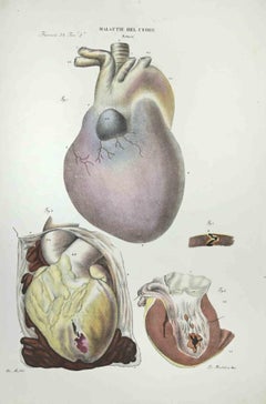 Heart Diseases - Lithograph By Ottavio Muzzi - 1843
