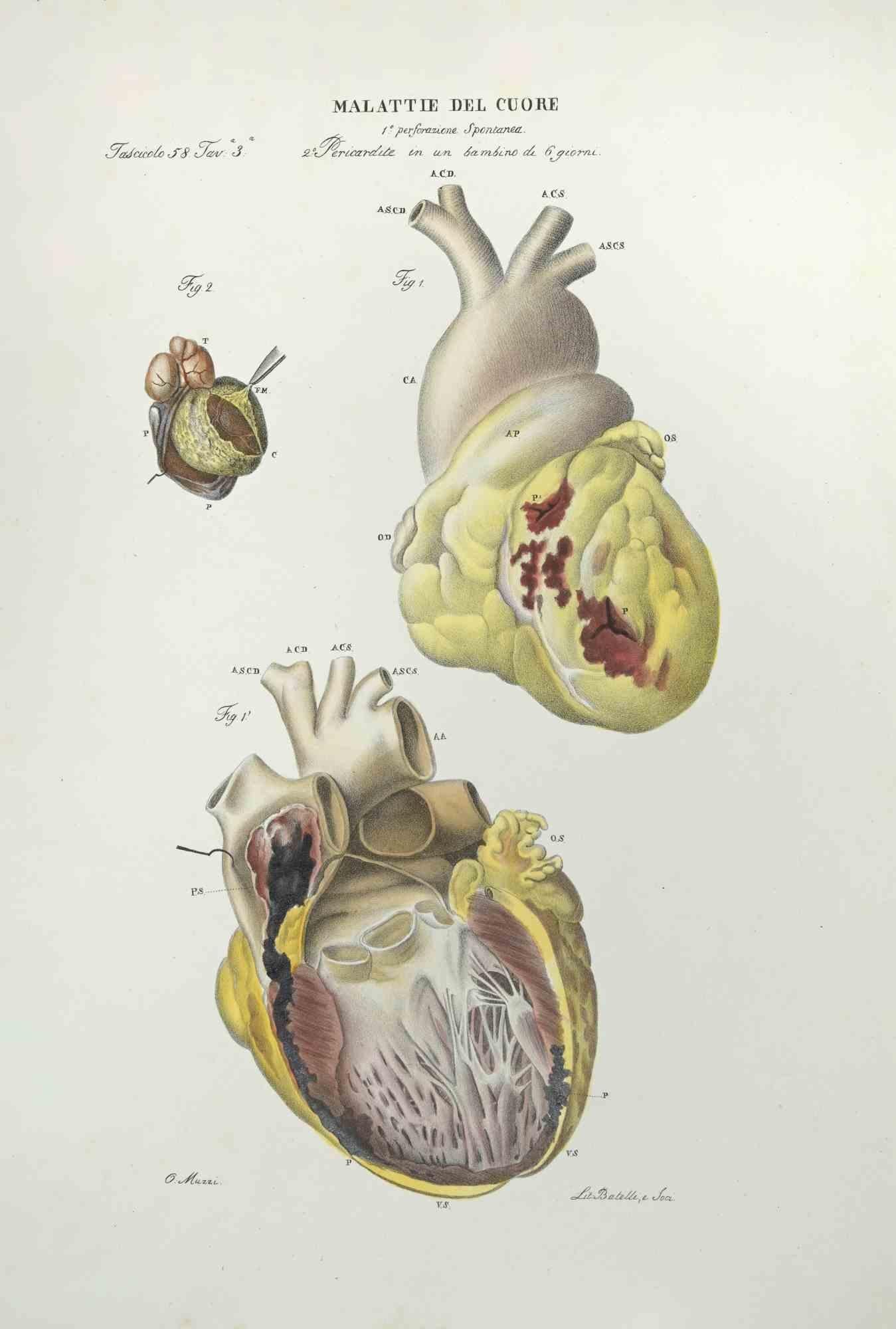 Heart Diseases is a lithograph hand colored by Ottavio Muzzi for the edition of Antoine Chazal,Human Anatomy, Printers Batelli and Ridolfi, realized in 1843.

Signed on plate on the lower left margin.

The artwork belongs to the "Atlante Generale