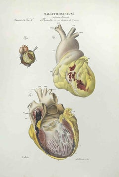 Herzkrankheiten – Lithographie von Ottavio Muzzi – 1843