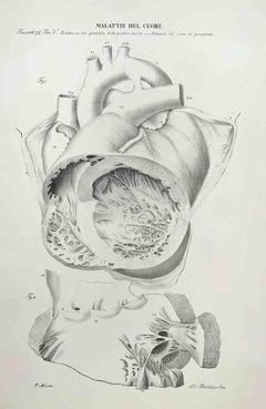 Herzkrankheiten – Lithographie von Ottavio Muzzi – 1843