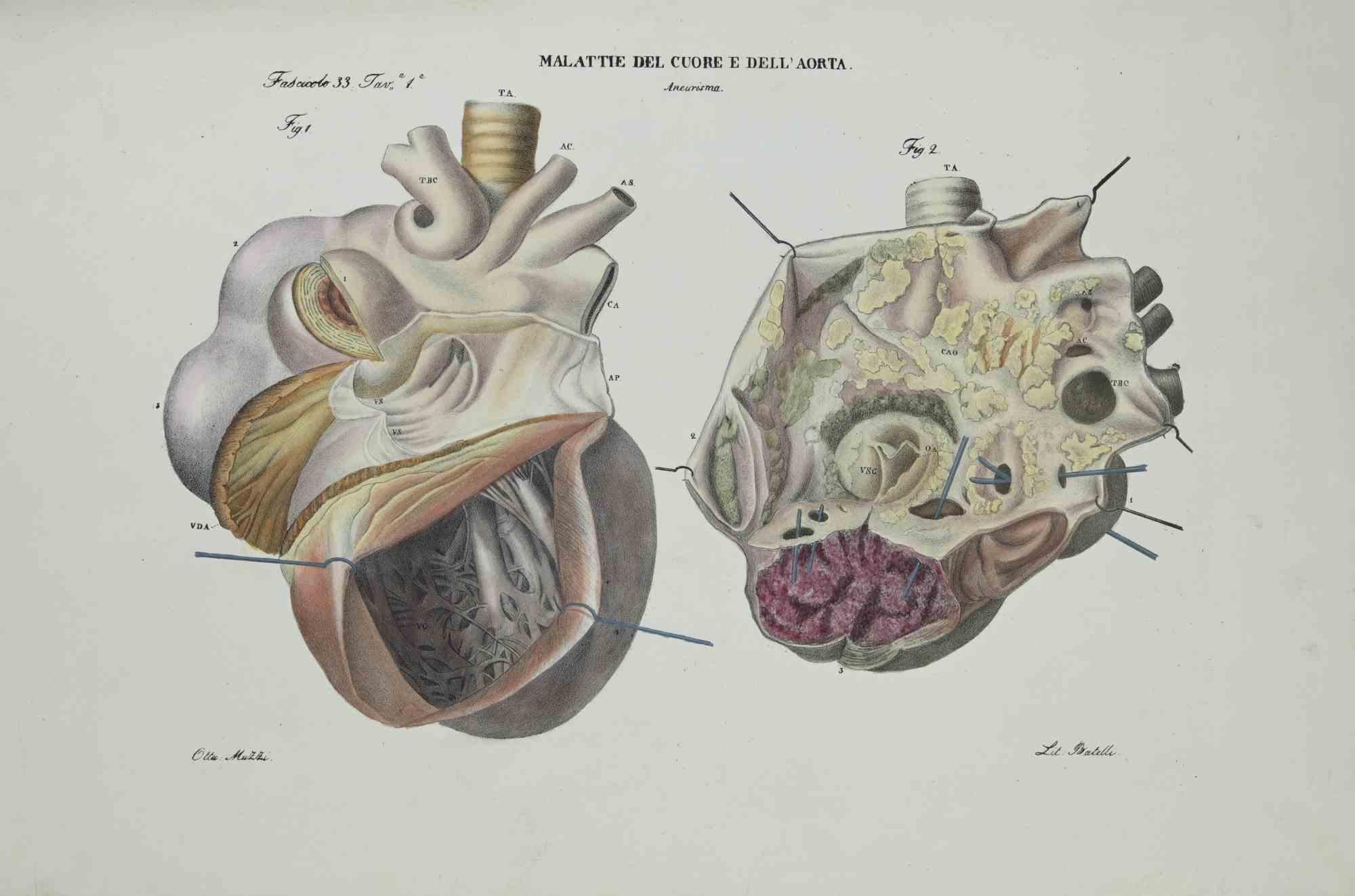 Heart Diseases is a lithograph hand colored by Ottavio Muzzi for the edition of Antoine Chazal,Human Anatomy, Printers Batelli and Ridolfi, realized in 1843.

Signed on plate on the lower left margin.