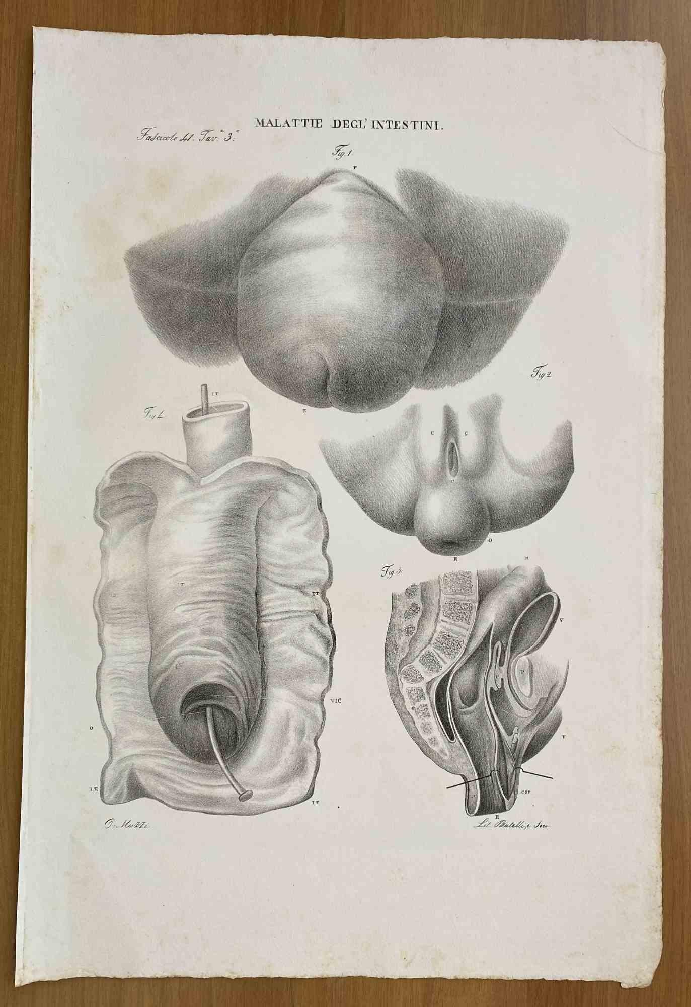  Maladies intestinales  est une lithographie coloriée à la main par Ottavio Muzzi pour l'édition d'Antoine Chazal, Anatomie humaine, Imprimeurs Batelli et Ridolfi, 1843.

L'ouvrage fait partie de l'Atlante generale della anatomia patologica del