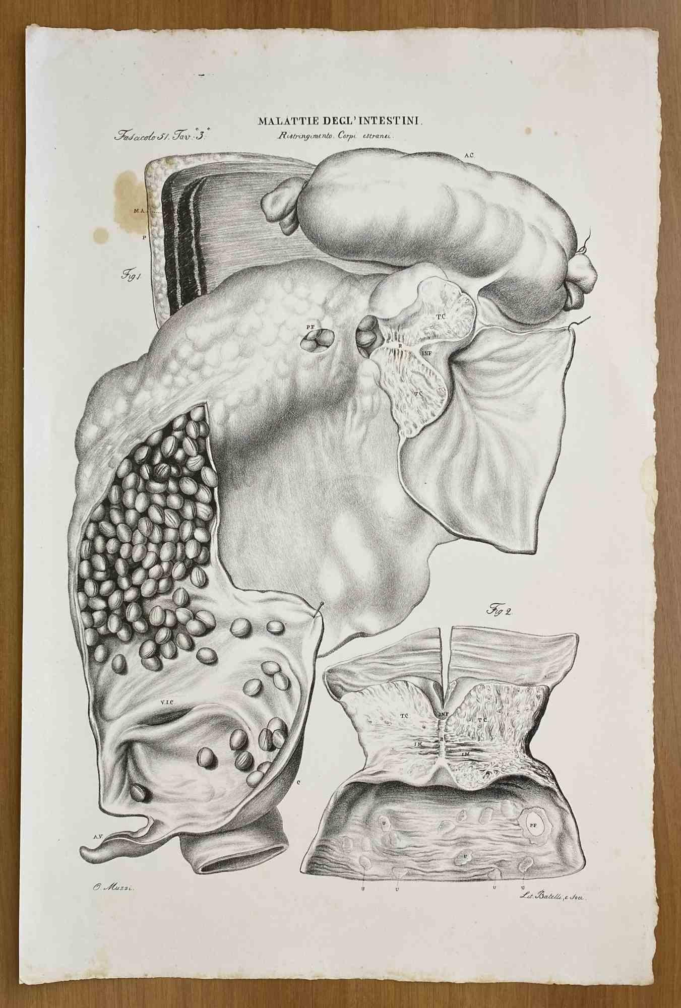 Intestinal Diseases ist eine handkolorierte Lithographie von Ottavio Muzzi für die Ausgabe von Antoine Chazal, Human Anatomy, Printers Batelli and Ridolfi, 1843.

Das Werk gehört zum Atlante generale della anatomia patologica del corpo umano von