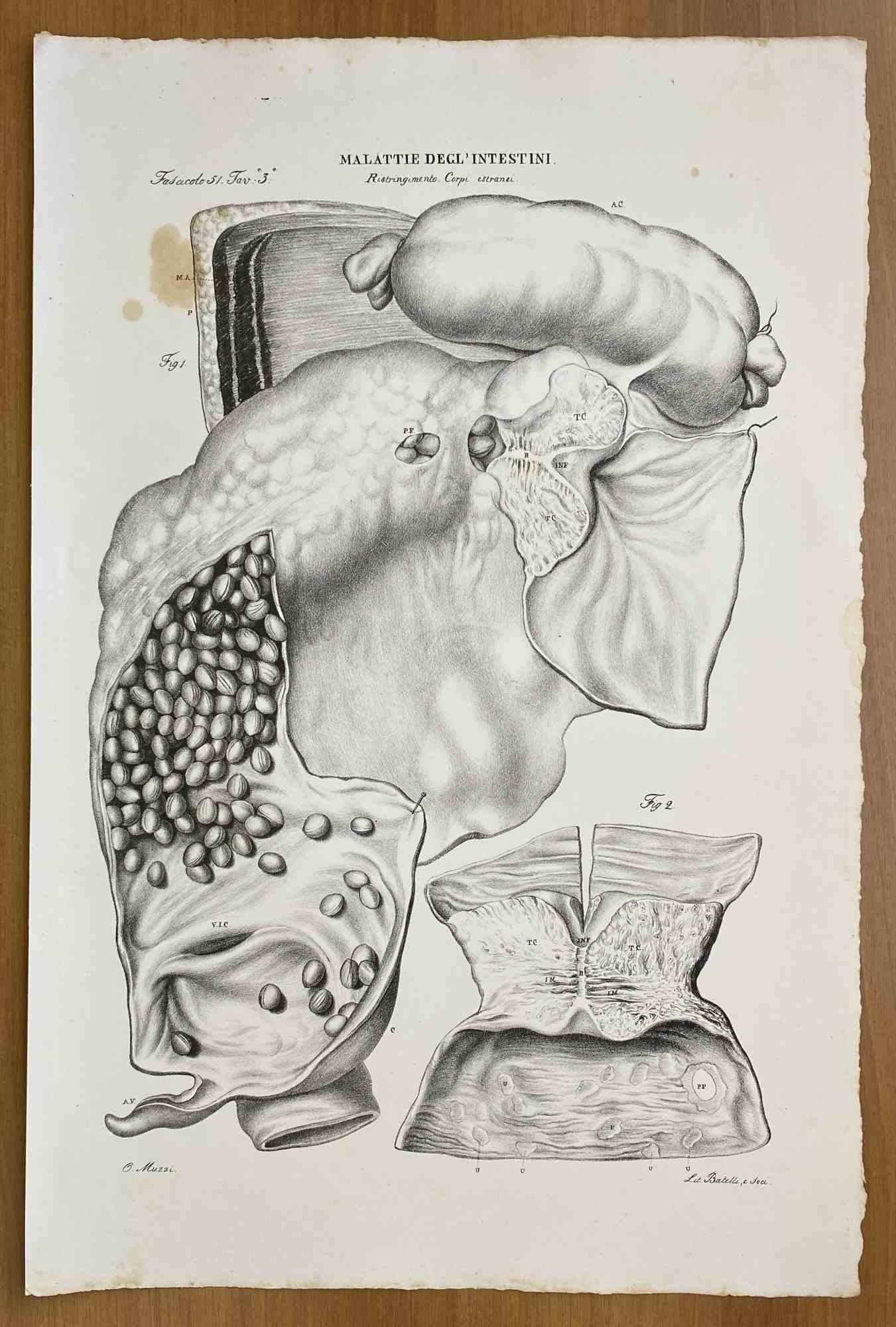 Intestinal Diseases - Lithograph By Ottavio Muzzi - 1843