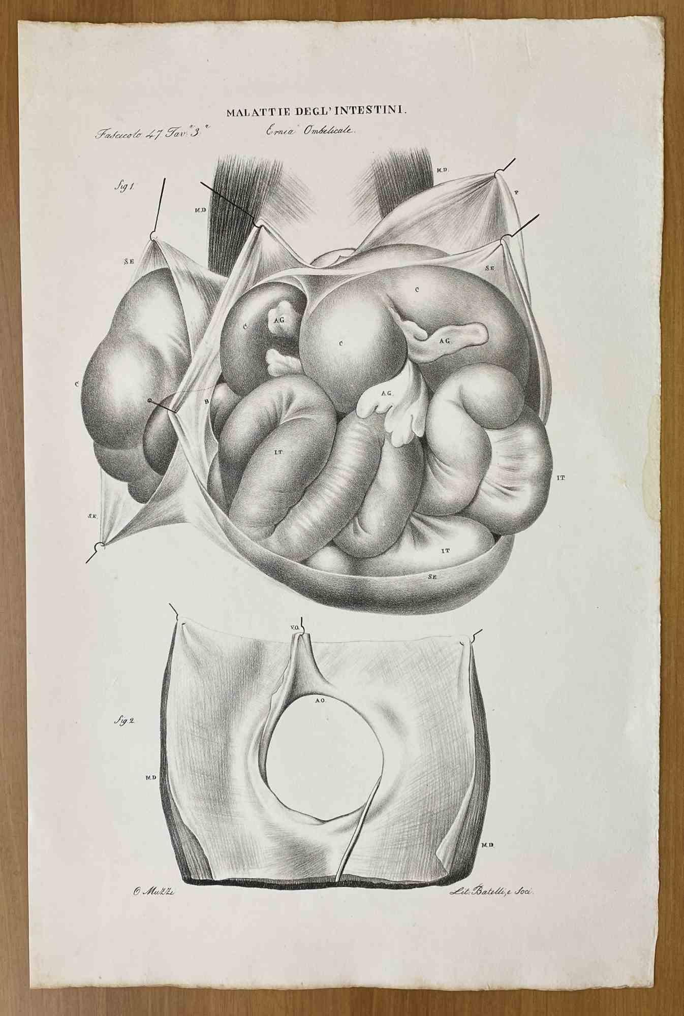 Lithographie sur les maladiesstiniques d'Ottavio Muzzi - 1843