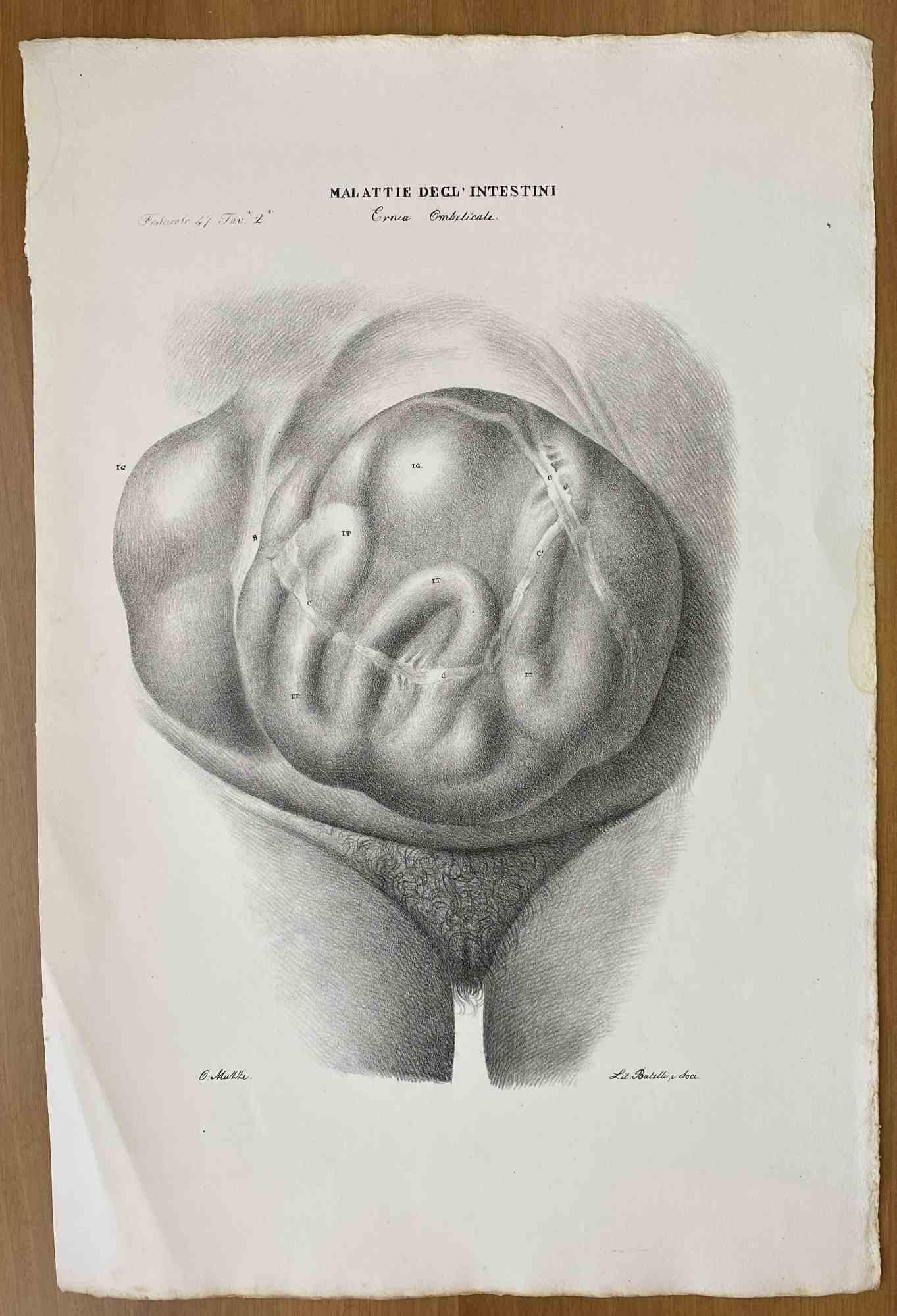 Defectos de Conformación es una litografía coloreada a mano por Ottavio Muzzi para la edición de Antoine Chazal, Anatomía Humana, Imprenta Batelli y Ridolfi, 1843.

La obra pertenece al Atlante generale della anatomia patologica del corpo umano de
