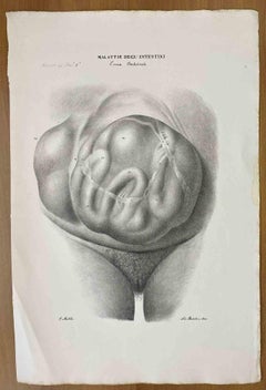 Intestinal Diseases – Lithographie von Ottavio Muzzi – 1843