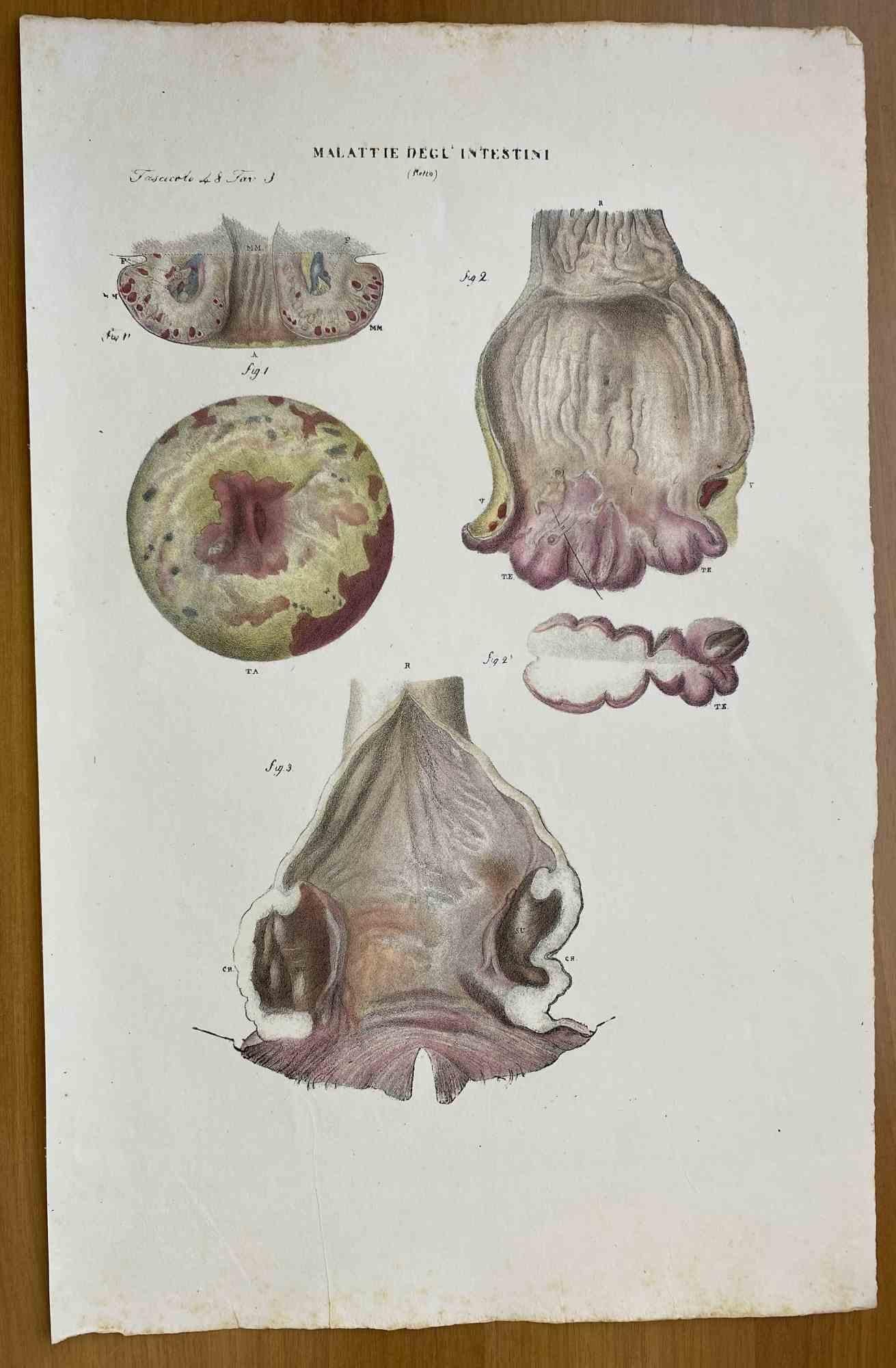 Intestine Diseases is a lithograph hand colored by Ottavio Muzzi for the edition of Antoine Chazal, Human Anatomy, Printers Batelli and Ridolfi, 1843.

The work belongs to the Atlante generale della anatomia patologica del corpo umano by Jean