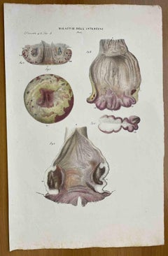 Intestine Diseases - Lithograph By Ottavio Muzzi - 1843