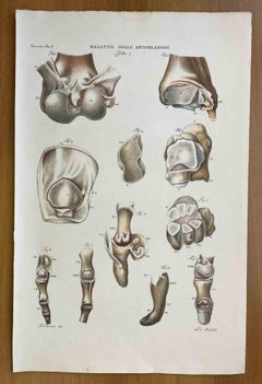 Joint Diseases - Lithograph By Ottavio Muzzi - 1843