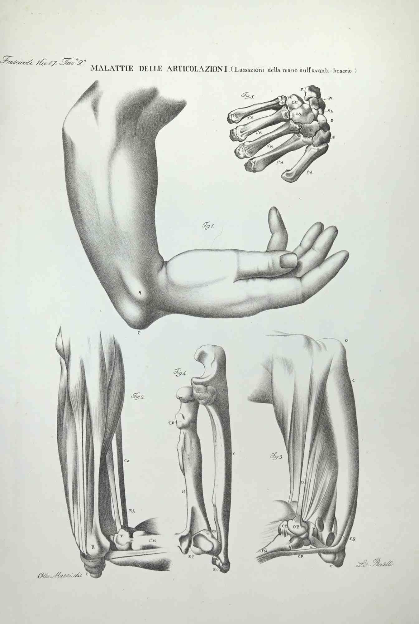 Joint Diseases is a lithograph hand colored by Ottavio Muzzi for the edition of Antoine Chazal, Human Anatomy, Printers Batelli and Ridolfi, 1843.

The work belongs to the Atlante generale della anatomia patologica del corpo umano by Jean