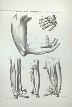 Antique Joint Diseases - Lithograph By Ottavio Muzzi - 1843