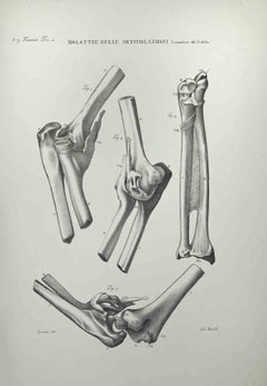 Malattie delle articolazioni - Litografia di Ottavio Muzzi - 1843