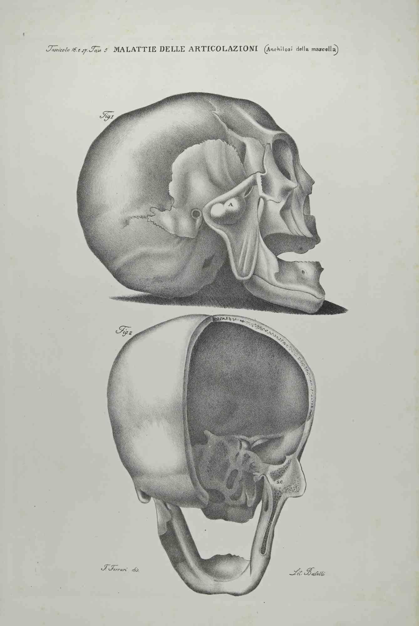 Joint Diseases is a lithograph hand colored by Ottavio Muzzi for the edition of Antoine Chazal, Human Anatomy, Printers Batelli and Ridolfi, 1843.

The work belongs to the Atlante generale della anatomia patologica del corpo umano by Jean