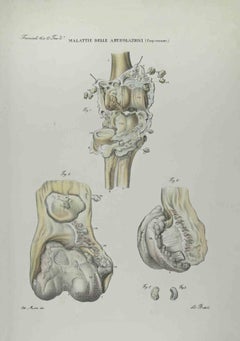Antique Joint Diseases - Lithograph By Ottavio Muzzi - 1843