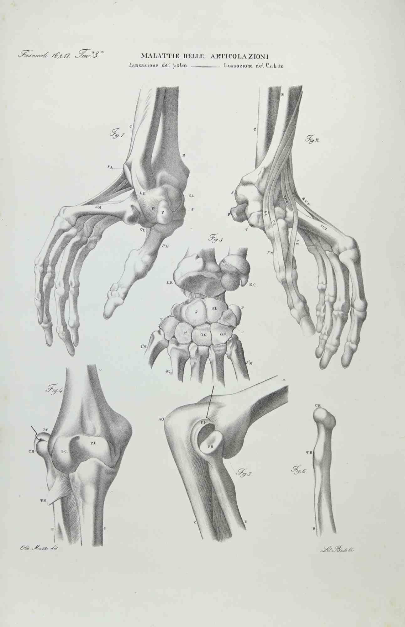 Joint Diseases is a lithograph hand colored by Ottavio Muzzi for the edition of Antoine Chazal, Human Anatomy, Printers Batelli and Ridolfi, realized in 1843.

Signed on plate on the left corner.

The artwork belongs to the "Atlante Generale della