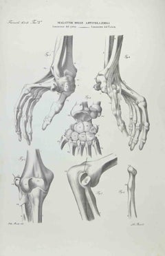Joint Diseases - Lithograph By Ottavio Muzzi - 1843