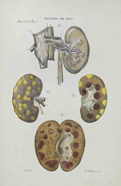 Kidney Disease - Lithograph By Ottavio Muzzi - 1843