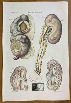Antique Kidney Diseases - Lithograph By Ottavio Muzzi - 1843