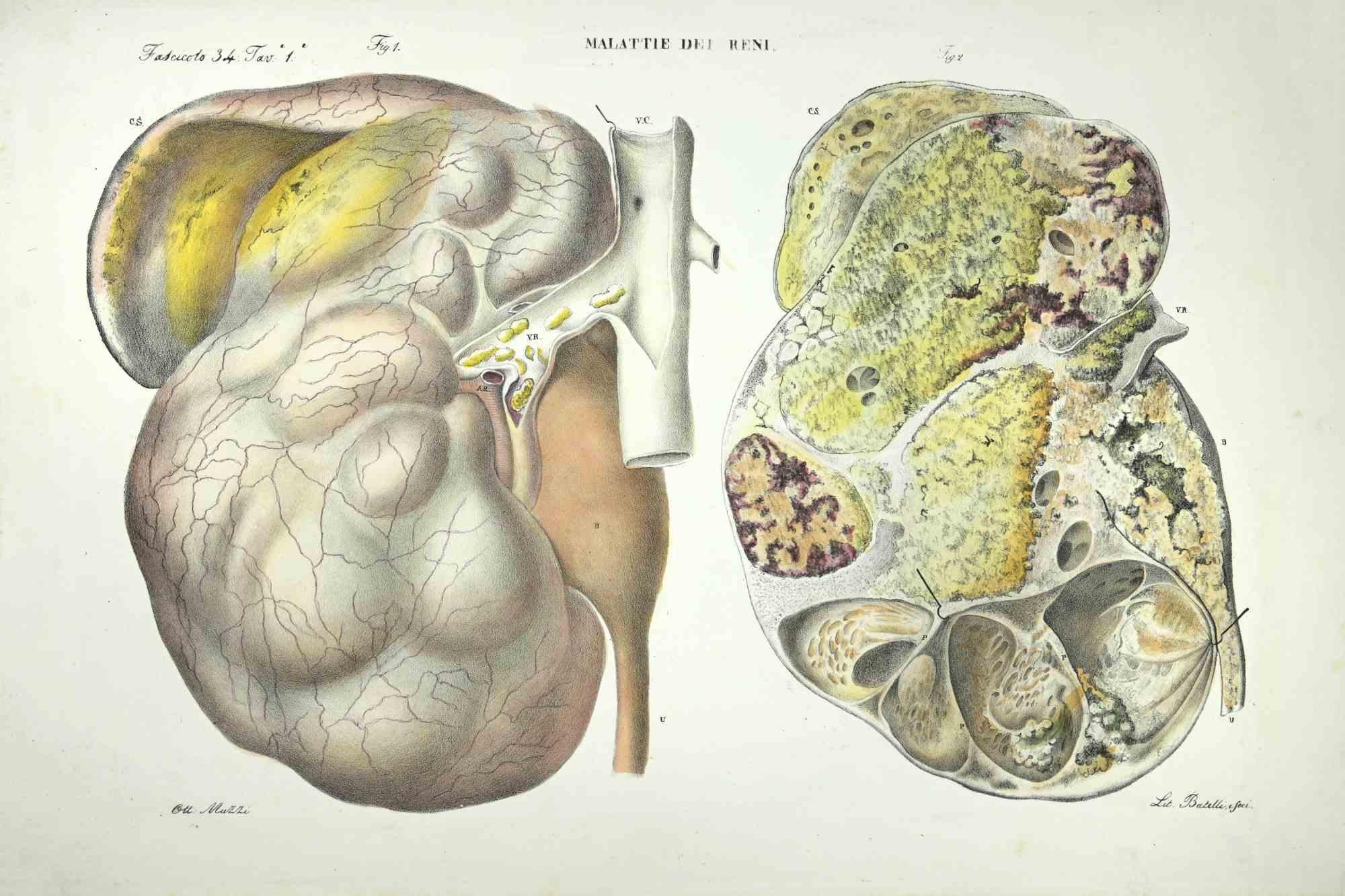 Knöchelkrankheiten – Lithographie von Ottavio Muzzi – 1843