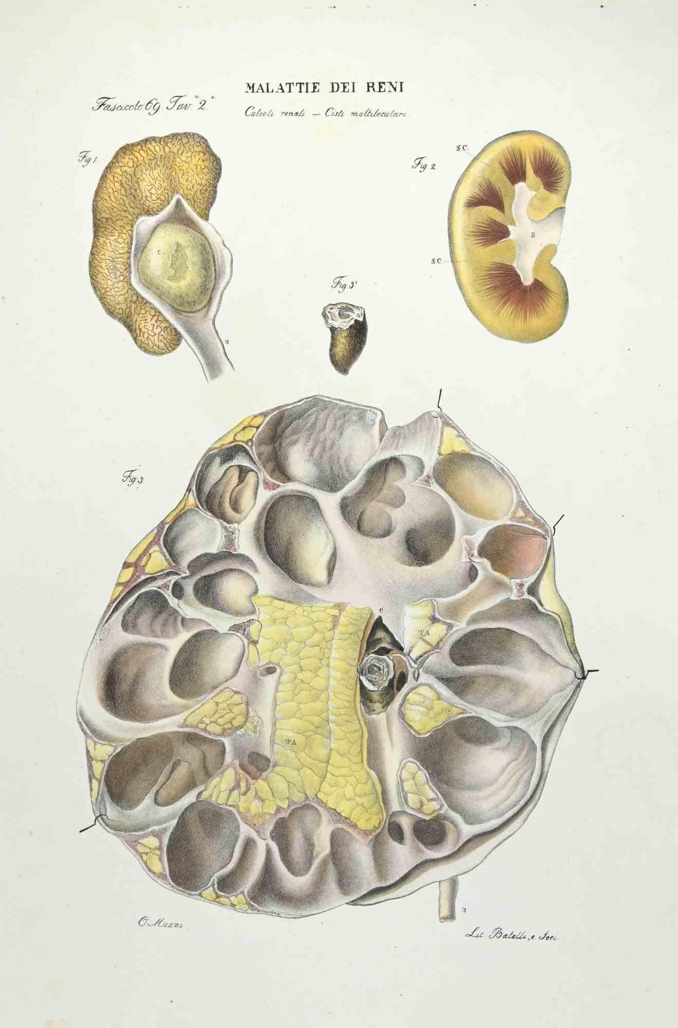 Kidney Diseases is a lithograph hand colored by Ottavio Muzzi for the edition of Antoine Chazal,Human Anatomy, Printers Batelli and Ridolfi, realized in 1843.

Signed on plate on the lower left margin.

The artwork belongs to the "Atlante Generale