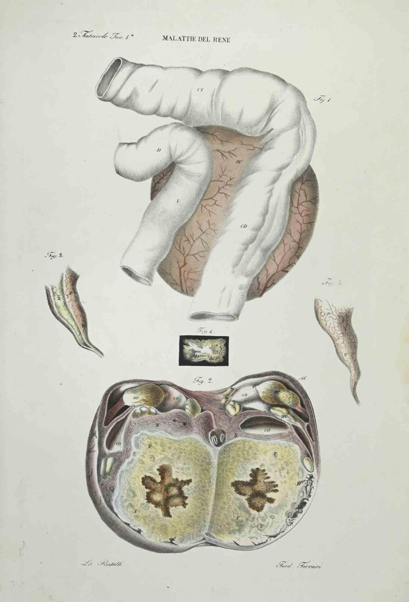 Kidney Diseases ist eine handkolorierte Lithographie von Ottavio Muzzi für die Ausgabe von Antoine Chazal, Human Anatomy, Printers Batelli and Ridolfi, aus dem Jahr 1843.

Signiert auf der Platte am unteren linken Rand.


