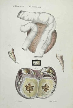 Lithographie sur les maladies de la reine par Ottavio Muzzi - 1843