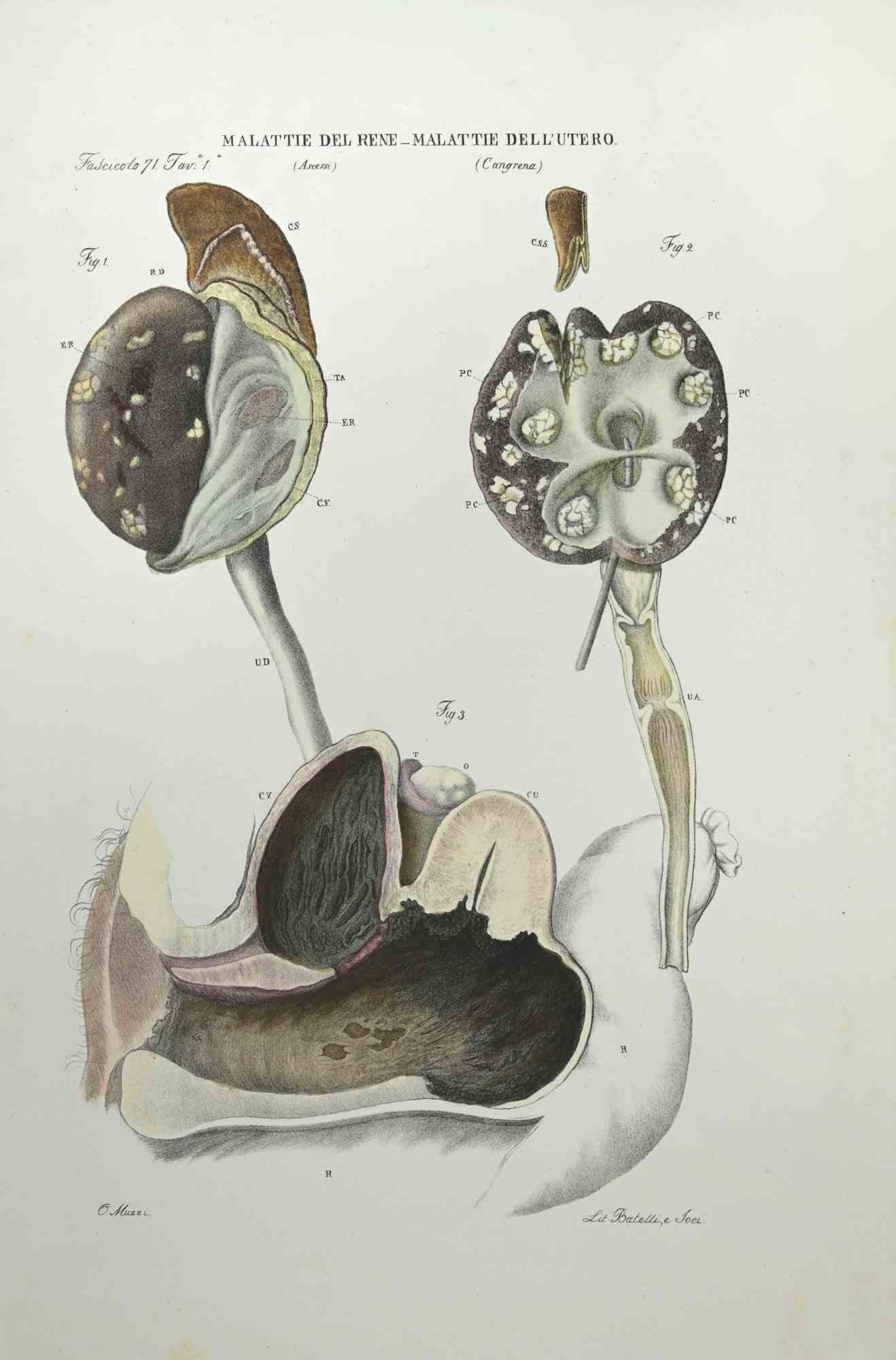Kidney Diseases Uterus Diseases is a lithograph hand colored by Ottavio Muzzi for the edition of Antoine Chazal,Human Anatomy, Printers Batelli and Ridolfi, realized in 1843.

Signed on plate on the lower left margin.

The artwork belongs to the