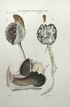 Kidney Diseases Uterus Diseases  - Lithograph By Ottavio Muzzi - 1843
