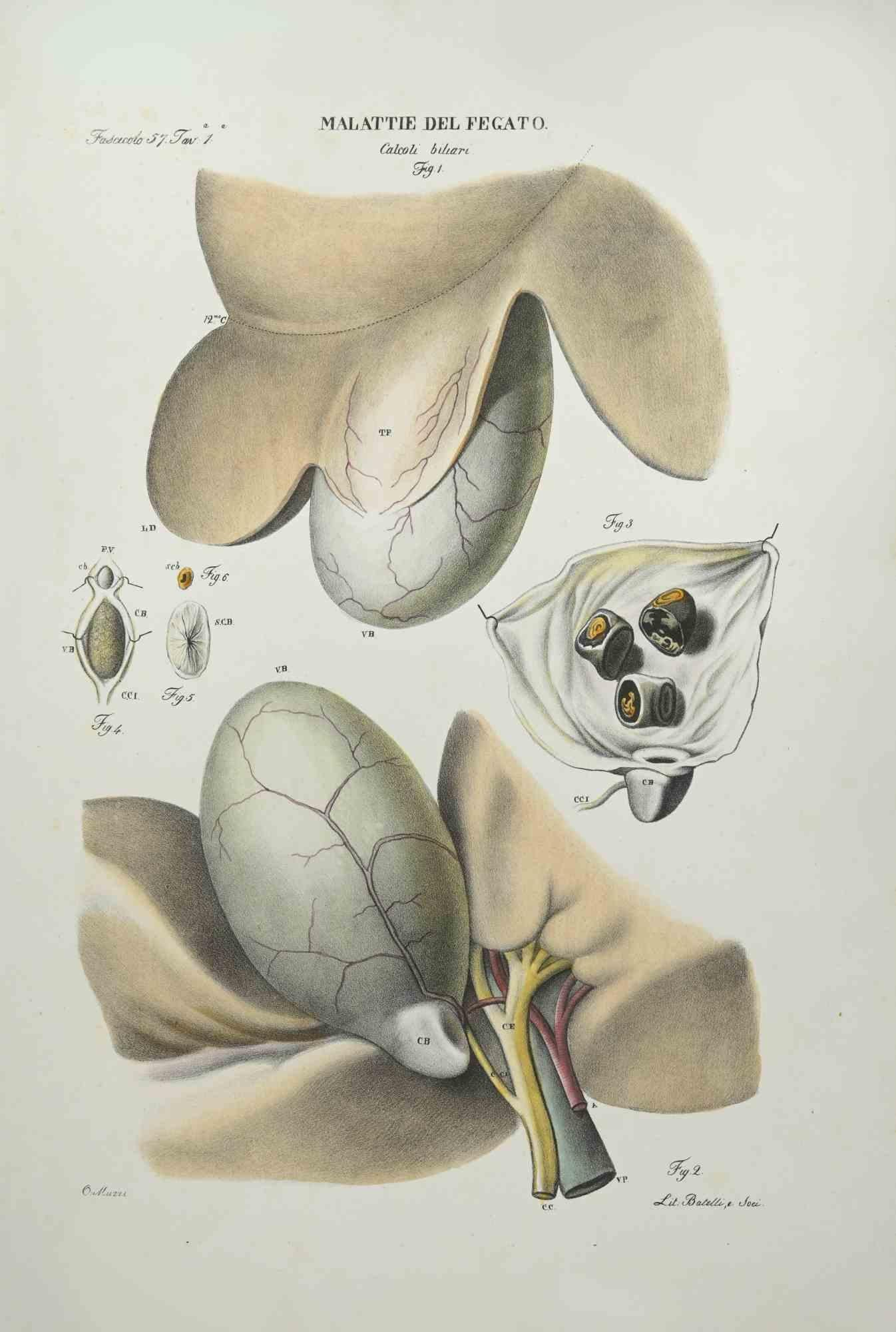 Lithographie « Liver Disease » d'Ottavio Muzzi, 1843