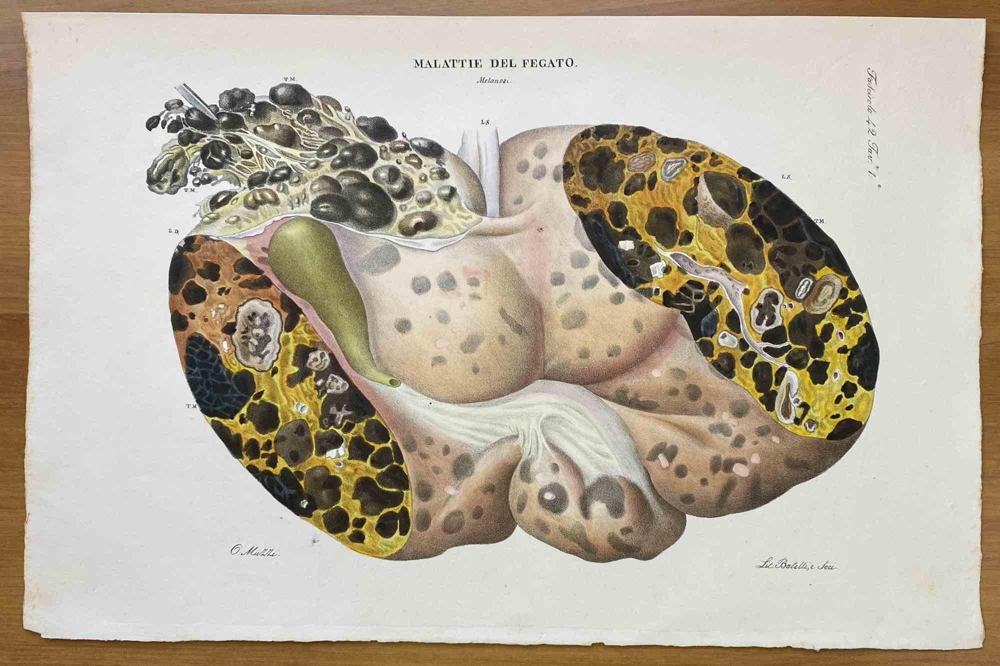 Liver Disease - Lithograph By Ottavio Muzzi - 1843