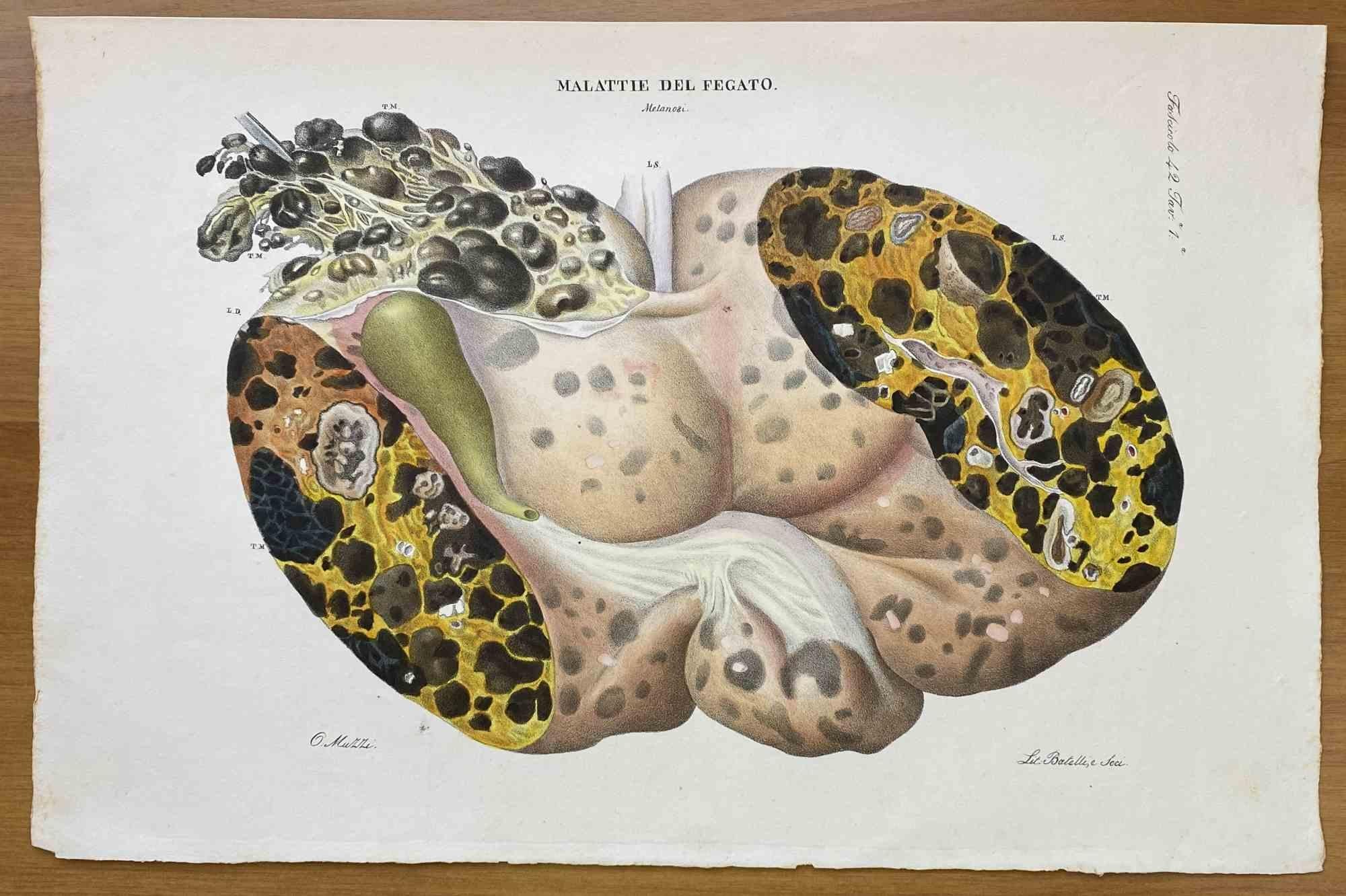  Liver Disease is a lithograph hand colored by Ottavio Muzzi for the edition of Antoine Chazal, Human Anatomy, Printers Batelli and Ridolfi, 1843.

The work belongs to the Atlante generale della anatomia patologica del corpo umano by Jean